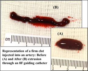 arteryclotcatheterimage