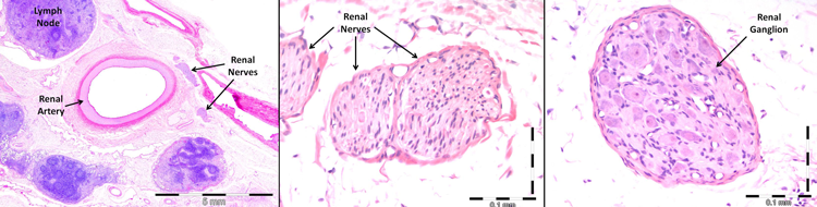 renaldenervation-images2